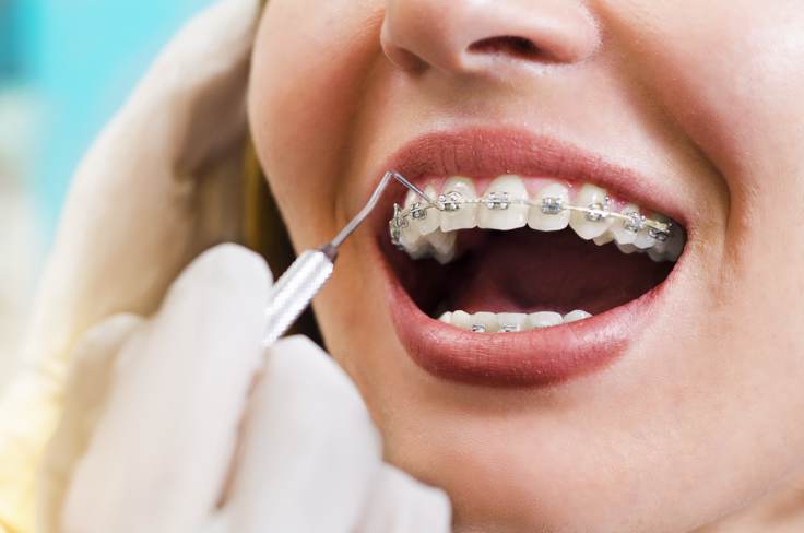 Questions-To-Ask-Before-Choosing-An-Orthodontist